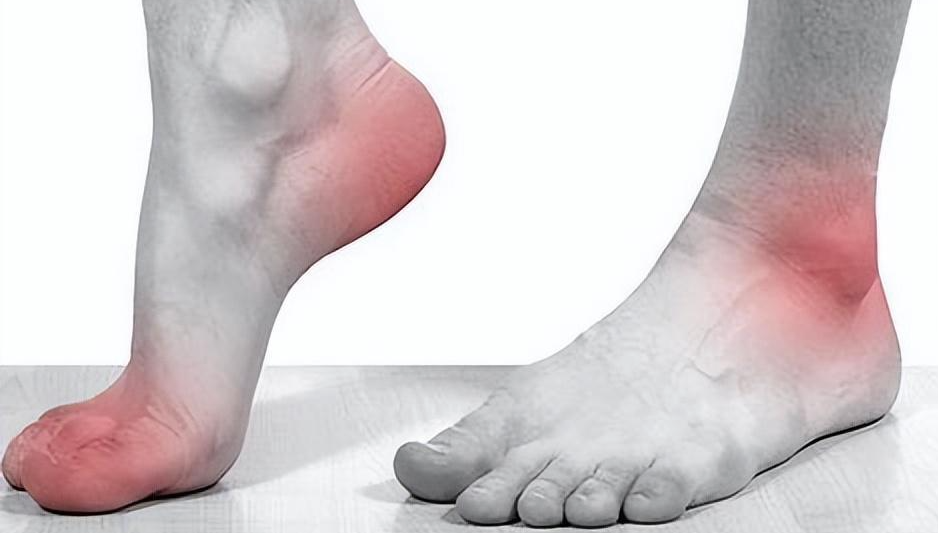 痛风别再只知道“忌口”了！教你吃出尿酸“代谢力”